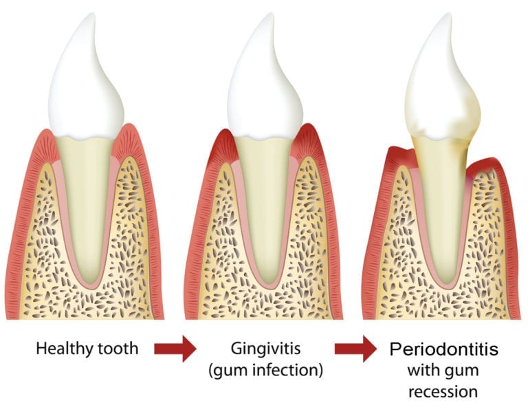 Gum Disease | Dentist in Charlotte, NC | Dentistry of the Queen City