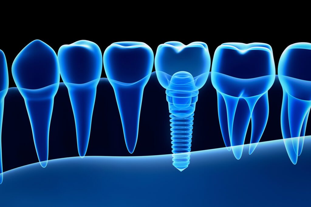 single dental implant in Charlotte, NC